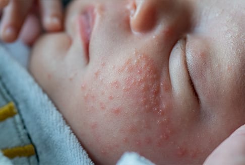 young baby with facial acne