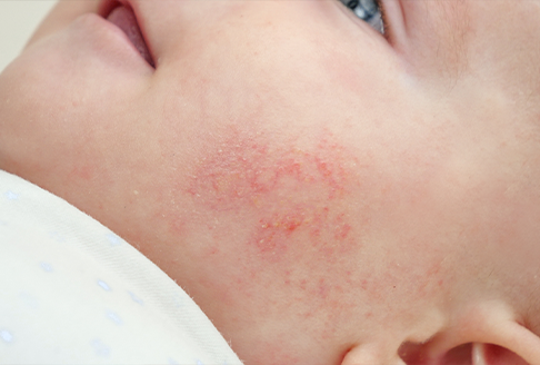 Newborn with acne