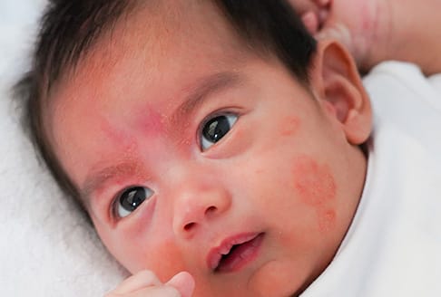 young baby with eczema