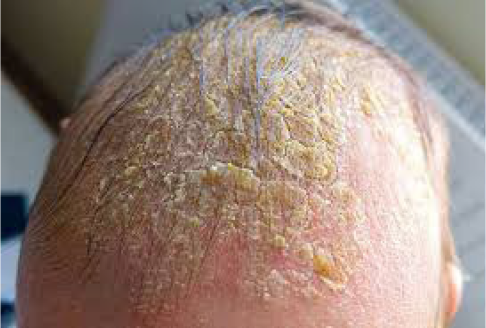 Cradle Cap rash