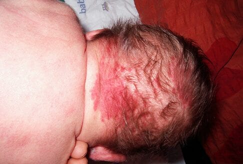 Salmon patch on a newborn