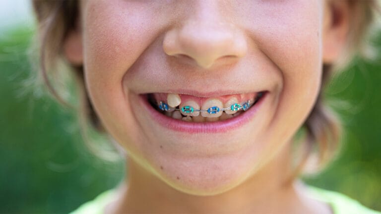 Closeup view of a child with uneven teeth and braces