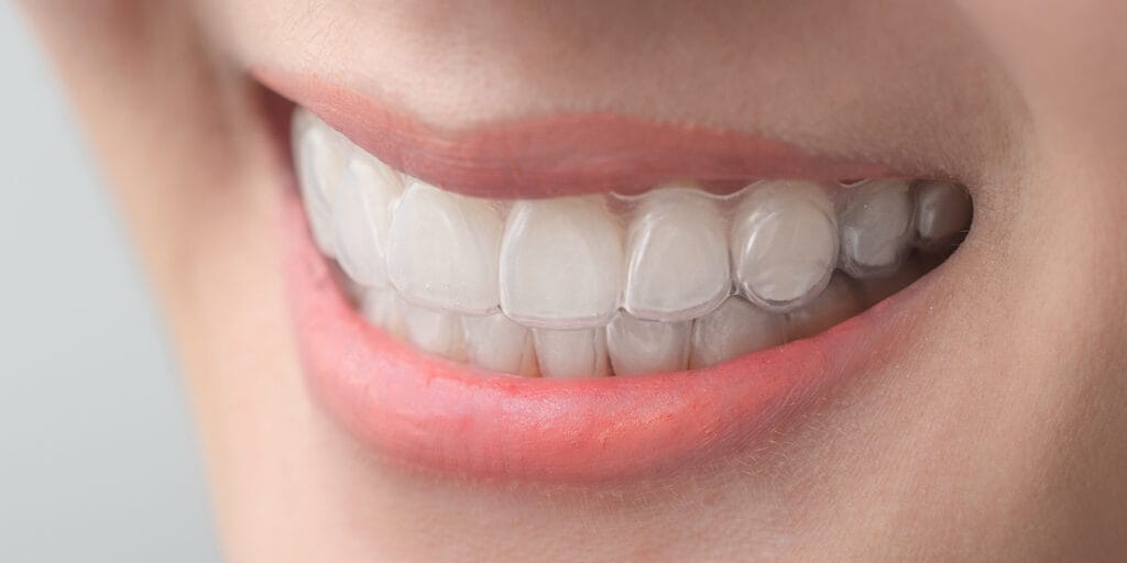 Smiling person showing clear aligners on their teeth
