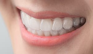 Smiling person showing clear aligners on their teeth