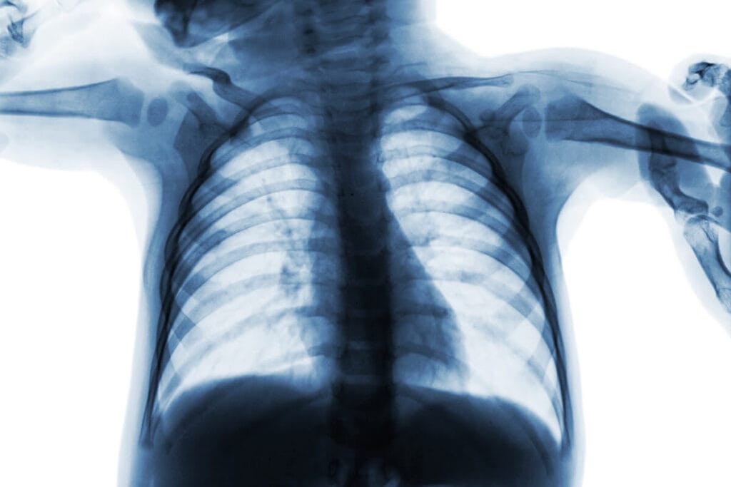 X-Ray showing a sick child's lungs.