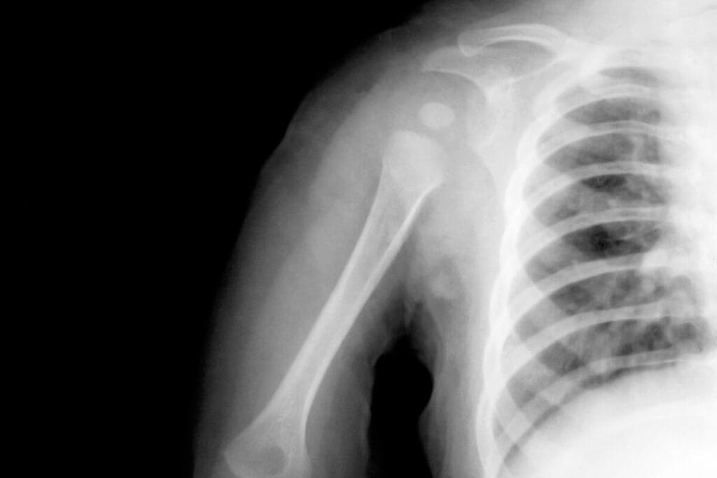 X-Ray scan showing an injured child's shoulder