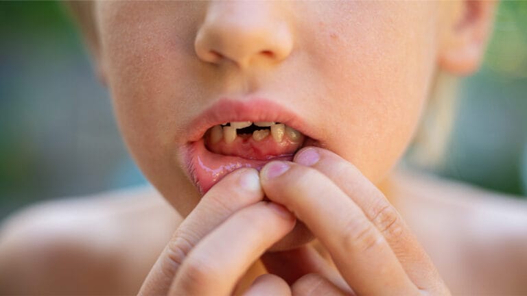 Child with missing tooth from injury