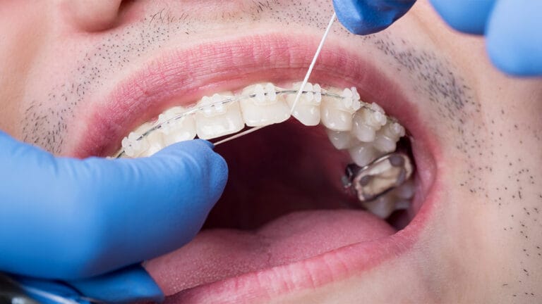 Dental hygienist flossing clear braces with a crown
