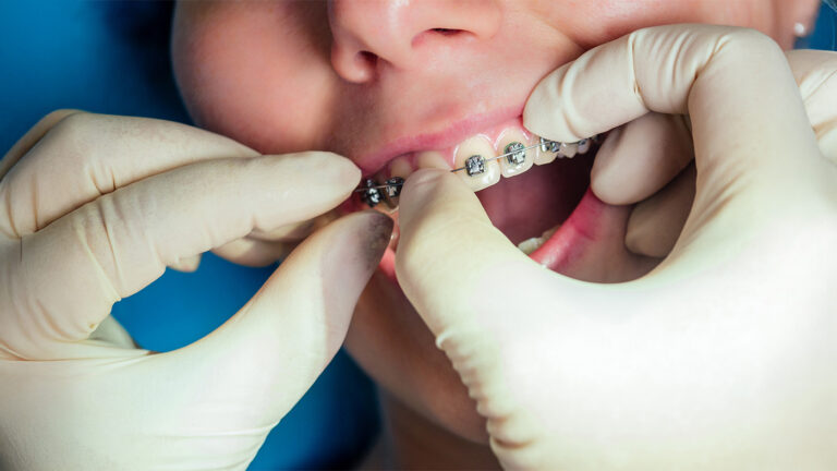 Orthodontist putting on braces