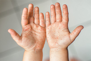 Hand Foot Mouth Disease