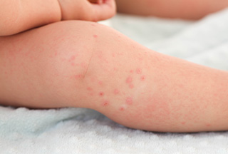 Hives