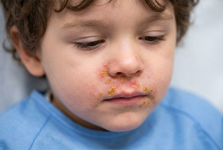 Impetigo