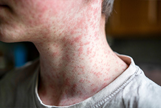 Measles
